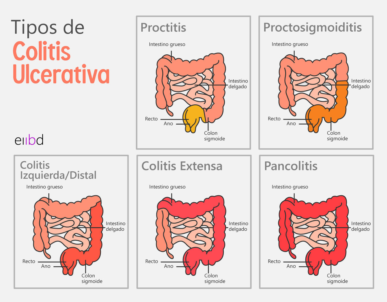 EIIBD-Imagen-Tipos de CUCI y Síntomas