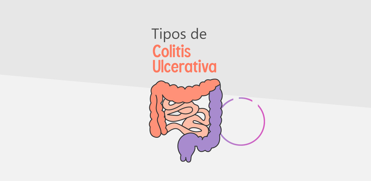 EIIBD-Imagen-Tipos de CUCI y Síntomas